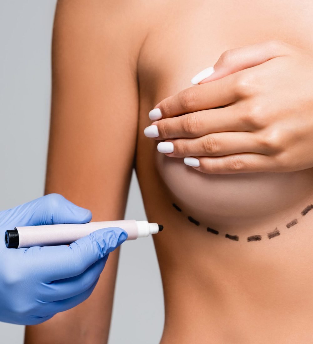 Cropped view of doctor in latex glove holding marker near naked woman with marks on breast isolated