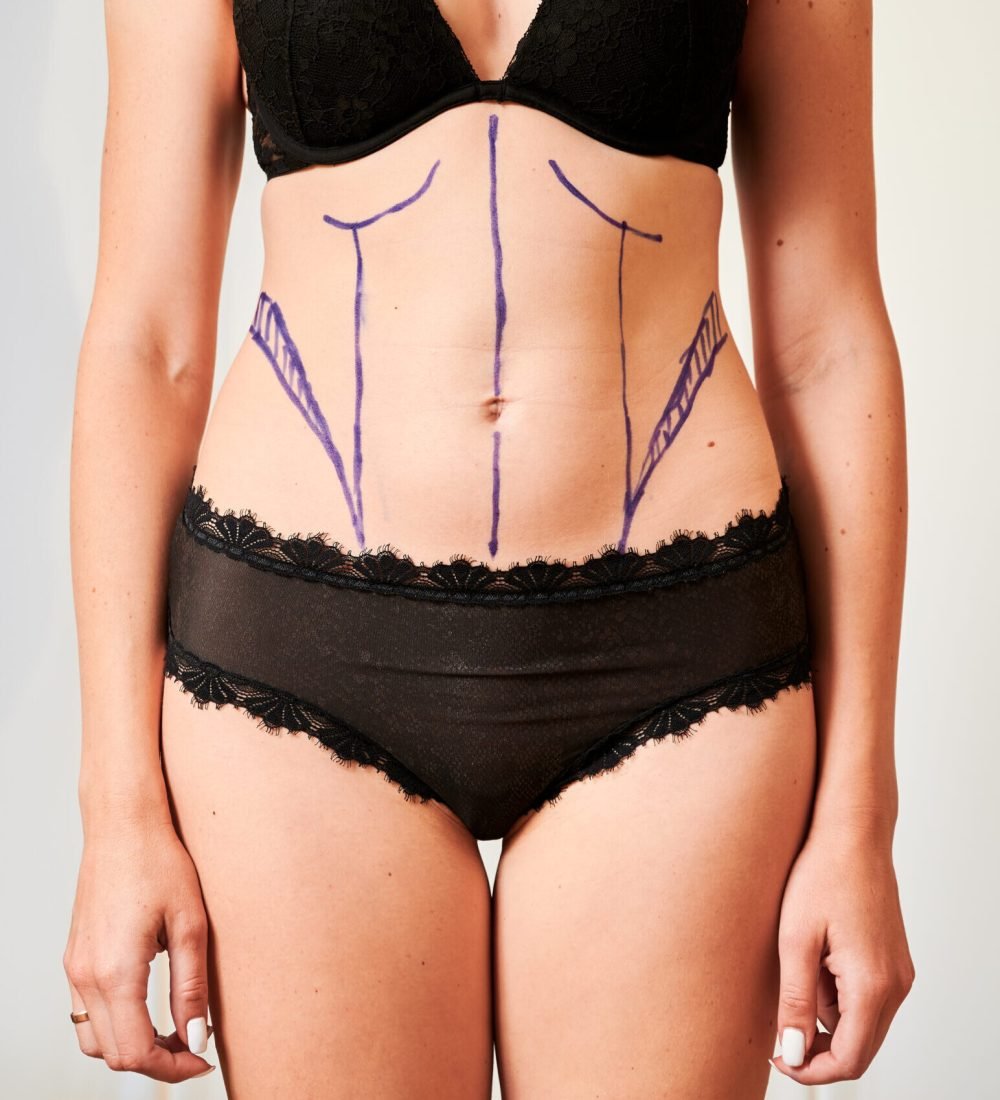 Horizontal snapshot of young woman patient in black underwear demonstrating results of preoperative marking procedure. Concept of excess weight and preparation for plastic surgery.