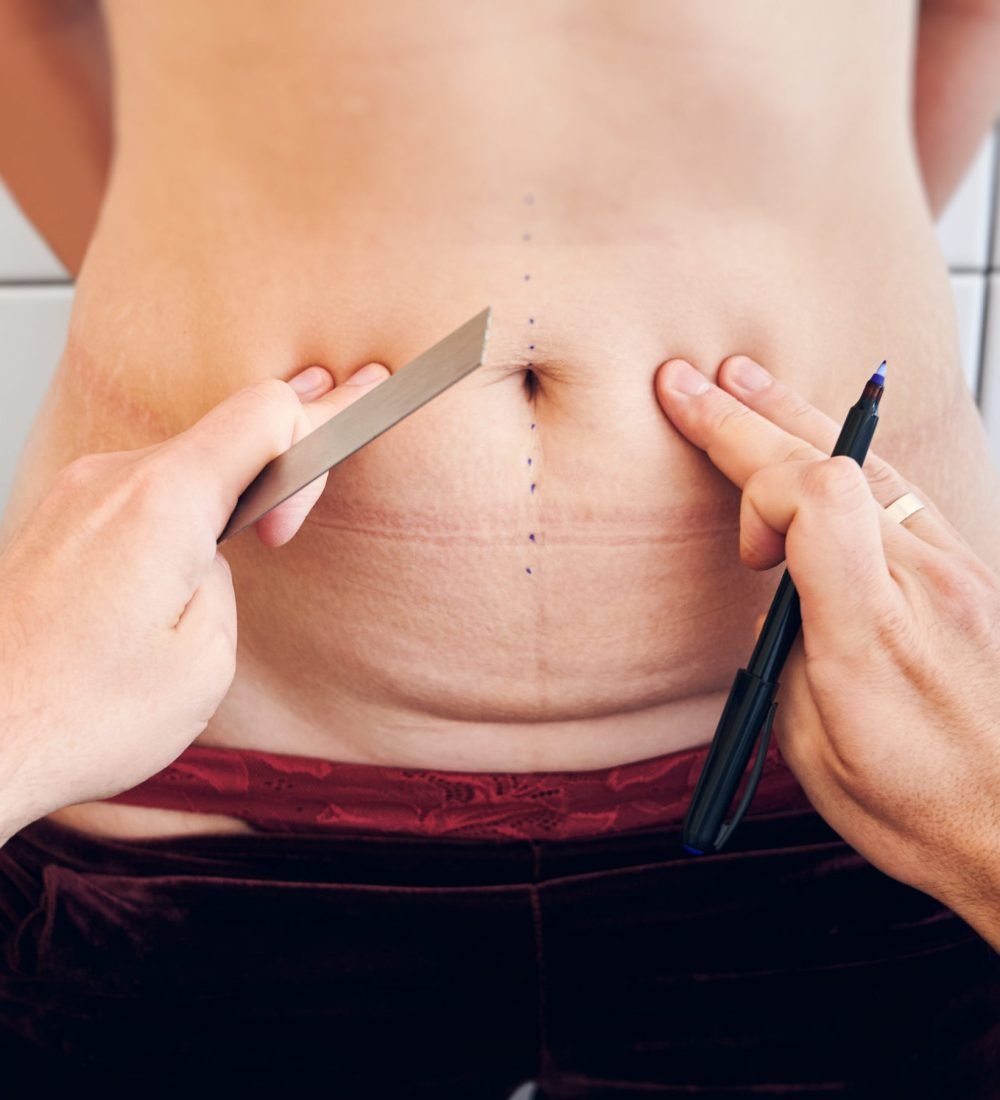 Close up of plastic surgeon hands holding ruler and marker pen while touching woman belly. Doctor measuring and marking abdomen of female patient before aesthetic surgery. Concept of abdominoplasty.